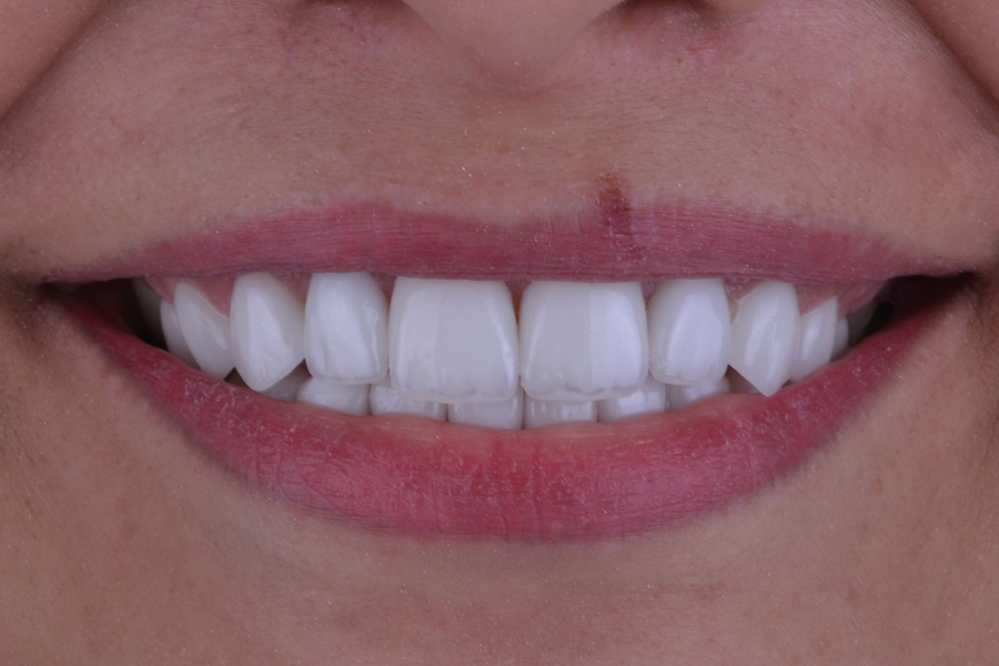 بعد تغير لون و شكل الأسنان لإعادة تأهيل الابتسامة.